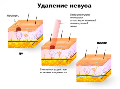 Изображение родинки в webp формате 