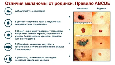 Родинка черного цвета на фото: как идеальное дополнение для вашего дизайна