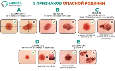 Прекрасные родинки телесного цвета: скачивайте бесплатно и наслаждайтесь