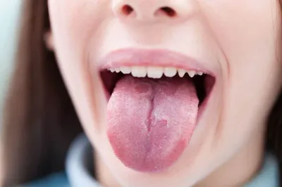 Цвет языка при раке желудка фотографии