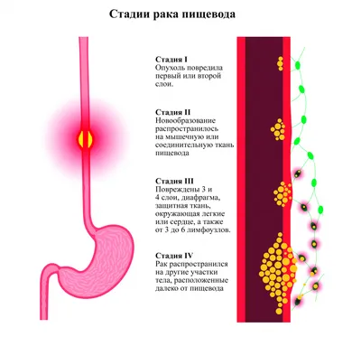 Графическое отражение заболевания: цветовая гамма языка при раке желудка