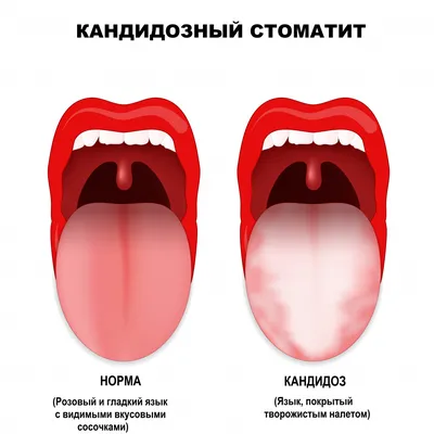 Цветовая палитра языка при раке желудка: визуальное руководство