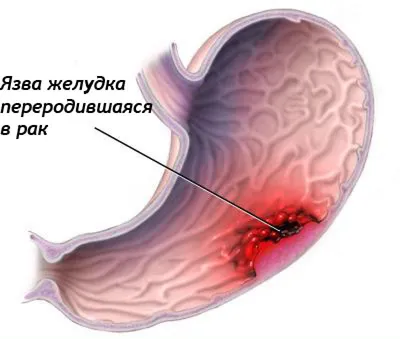 Взгляд внутрь: фотографии языка при раке желудка