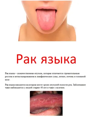 Фотографии языка при раке желудка: выберите размер и скачайте бесплатно