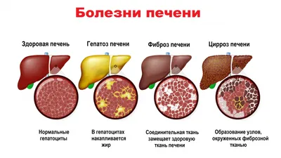 Познакомьтесь с новыми фото цвета кала при гепатите