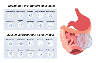 Фото цветного кала - признак гепатита?