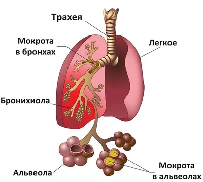 Цвет мокроты при туберкулезе: фото с подробной информацией