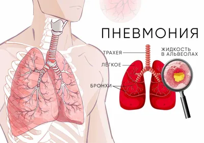 Ярко-красная мокрота: необычное проявление туберкулеза (Фото)