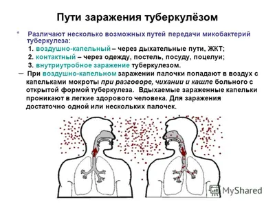 Скачать фото мокроты при туберкулезе - Бесплатное получение