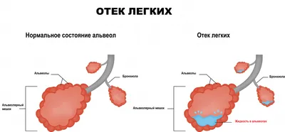 В хорошем качестве фото мокроты при туберкулезе - Пластичность цвета