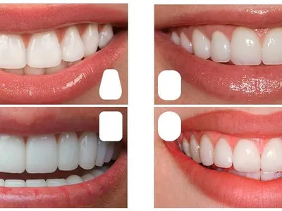 Фотографии с примерами Цвет зубов а1: выбирайте наилучший оттенок для ваших нужд