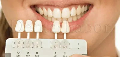 Цветные зубы: фотографии с а1 оттенком
