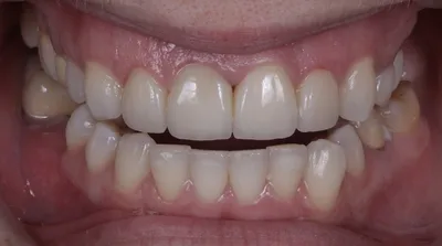 Фотография: Образец цвета зубов а1