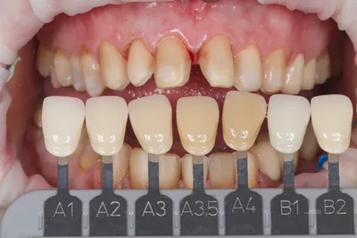 Яркий Цвет зубов а1 на фото: красочные изображения в высоком разрешении