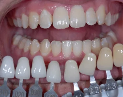 Фото Цвет зубов b1: выбирайте размер и качество изображения для загрузки