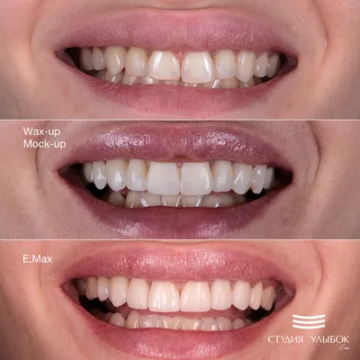 Цвет зубов b1: прекрасные улыбки на фото