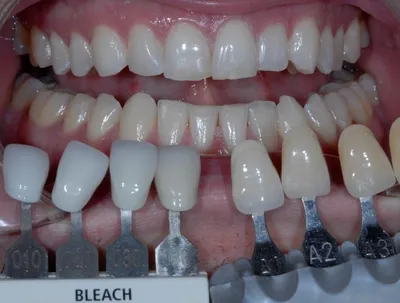 Цвет зубов b1: самые привлекательные улыбки на фото
