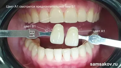 Фото мастерски отражают цвет зубов b1 и естественность улыбок