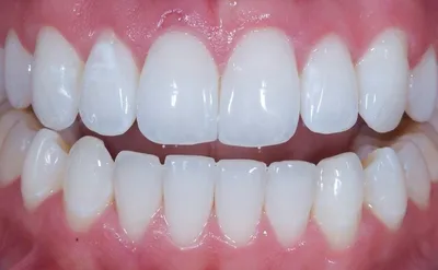 Рисунок зубов b1: красота и здоровье в каждой улыбке
