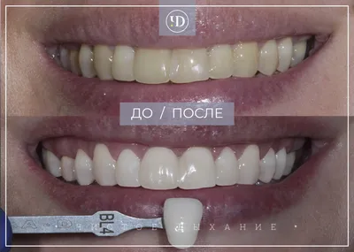 Изображение зубов b1 для android: яркий цветопередача для вашего удовольствия