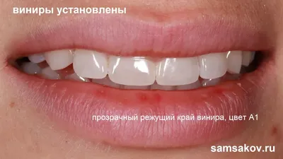 Абстрактное искусство: потрясающие Виниры цвета а1 на фотографиях