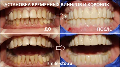 Бесплатные фотки Виниры цвет а1: прекрасное дополнение к вашим проектам