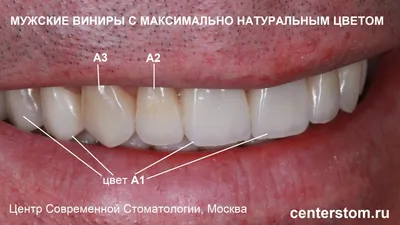 Виниры цвет а1: стильные картинки с цветочными мотивами