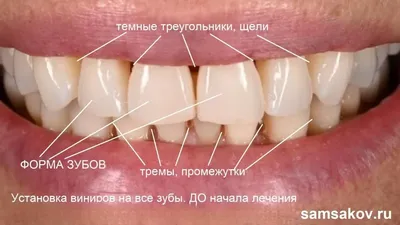 Виниры цвет а1: фотки в современных форматах - png, jpg, webp, gif