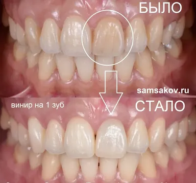 Виниры цвет а2: скачайте фотографии в высоком разрешении