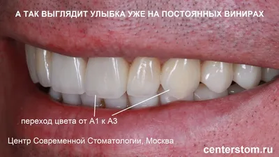 Цветы и цвета: Виниры цвет в1 в фокусе