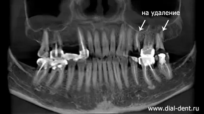 Имплантация зубов в Минске, цены на установку зубных имплантов под ключ