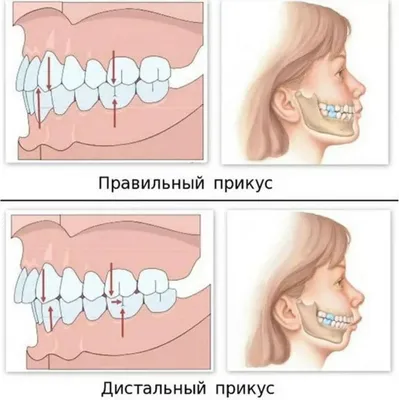 Удаление зубного камня – цена в Москве на снятие камней с зубов в  стоматологии