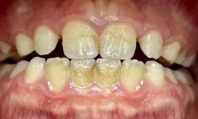 Зачем чистить зубы у стоматолога?🦷 Профессиональная чистка | iStomatolog,  Киев