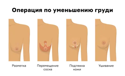 Удаление гинекомастии у мужчин