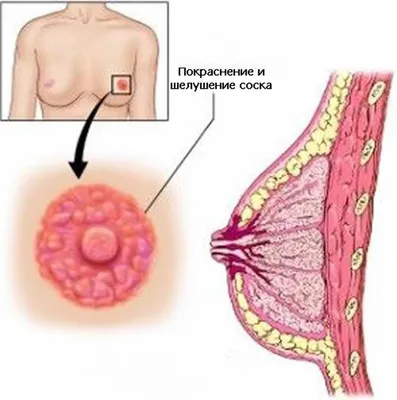 О чём говорят выделения из сосков - Лайфхакер