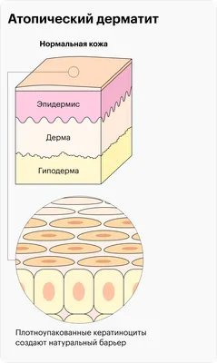 Аллергия на молоко, молочные продукты: симптомы, причины и лечение |  Открытая Клиника | Дзен