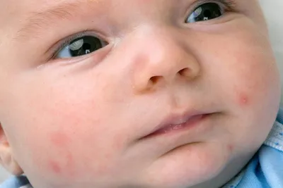 Аллергии, прыщи на коже ребенка Аллергия на продукты питания Стоковое  Изображение - изображение насчитывающей реакция, вакханические: 160495467