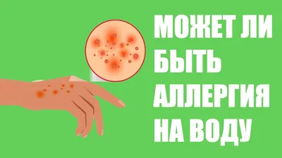 Аллергия на воду — реальность?