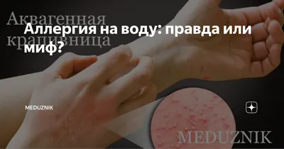 https://www.kp.ru/doctor/bolezni/allergiya-na-vodu-u-vzroslyh/