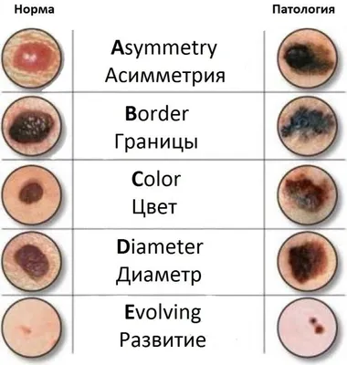 Ихтиоз: что это за болезнь кожи, лечение симптомы, причины, виды