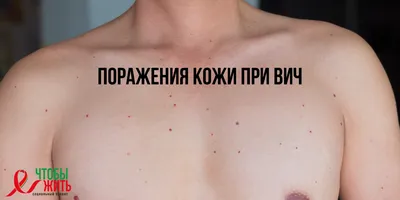 Кожные Заболевания На Кавказский Бюст Человека — стоковые фотографии и  другие картинки Болезни кожи - Болезни кожи, Болезнь, Взрослый - iStock