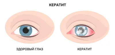 Болезни век у человека фото