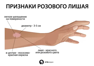 Чем лечить розовый лишай у человека фото