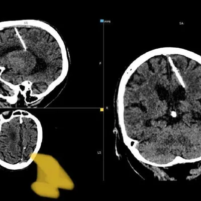 Врачи обнаружили у 80-летний женщины иголку в мозге, с которой она прожила  всю жизнь - Чемпионат