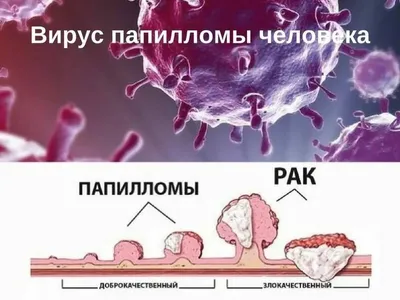 ВПЧ (вирус папилломы человека) | причины, симптомы, типы, диагностика и  лечение папилломавирусной инфекции