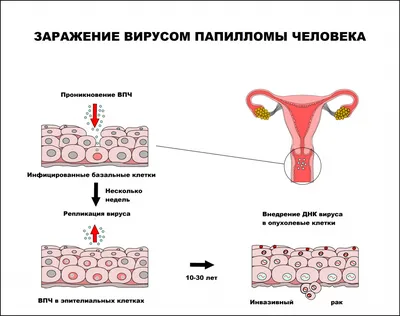 ВПЧ, вирус папилломы человека - причины появления, симптомы заболевания,  диагностика и способы лечения