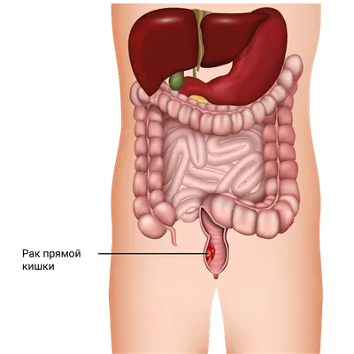 Рак прямой кишки