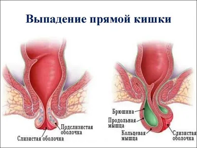 Язва двенадцатиперстной кишки – симптомы и лечение – блог Медюнион