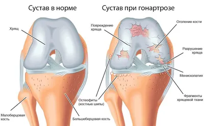 Человека коленного сустава с модель Связки, коленного сустава анатомическая  модель, подвижный, анатомическая модель | AliExpress