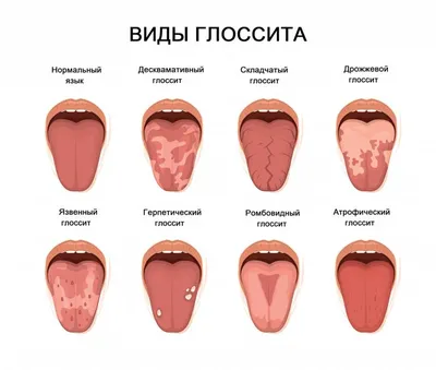 Язык покажет чем болеете | Будь здоров | Дзен